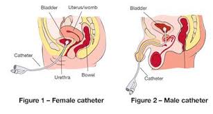 male-female-catheter-options-best-urologist-nyc-03